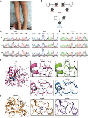 Novel Mutations in ACP5 and SAMHD1 in a Patient With Pediatric Systemic Lupus Erythematosus